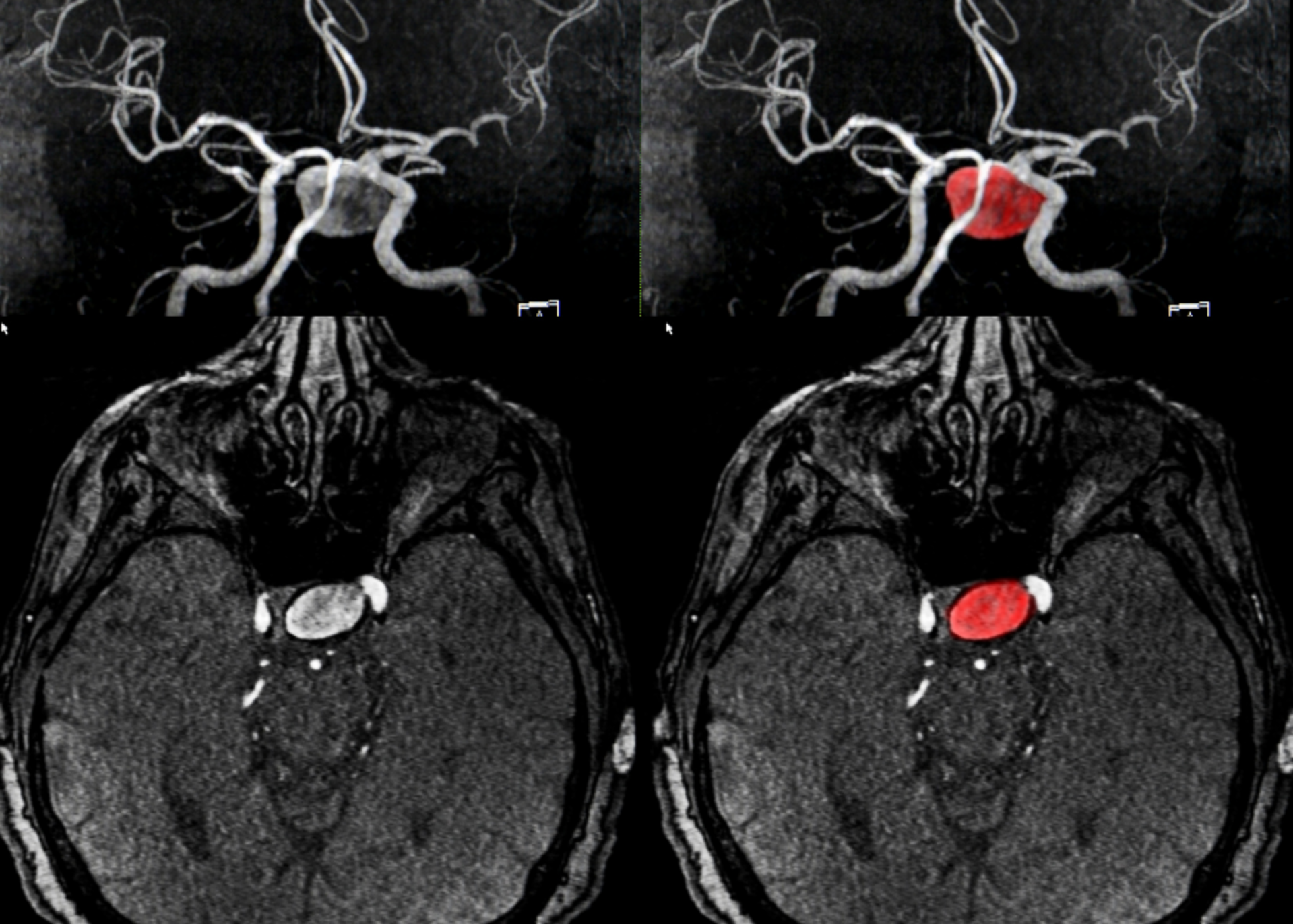 Aneurysm Clipping &amp; Endovascular Coiling