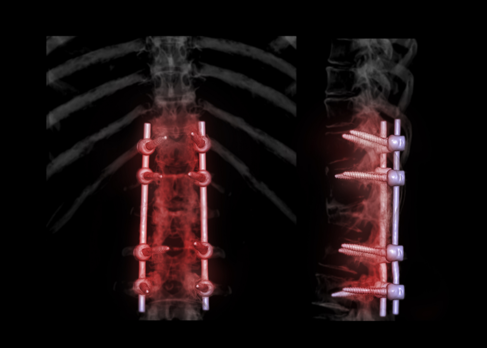 Spinal Fusion Surgery for Instability