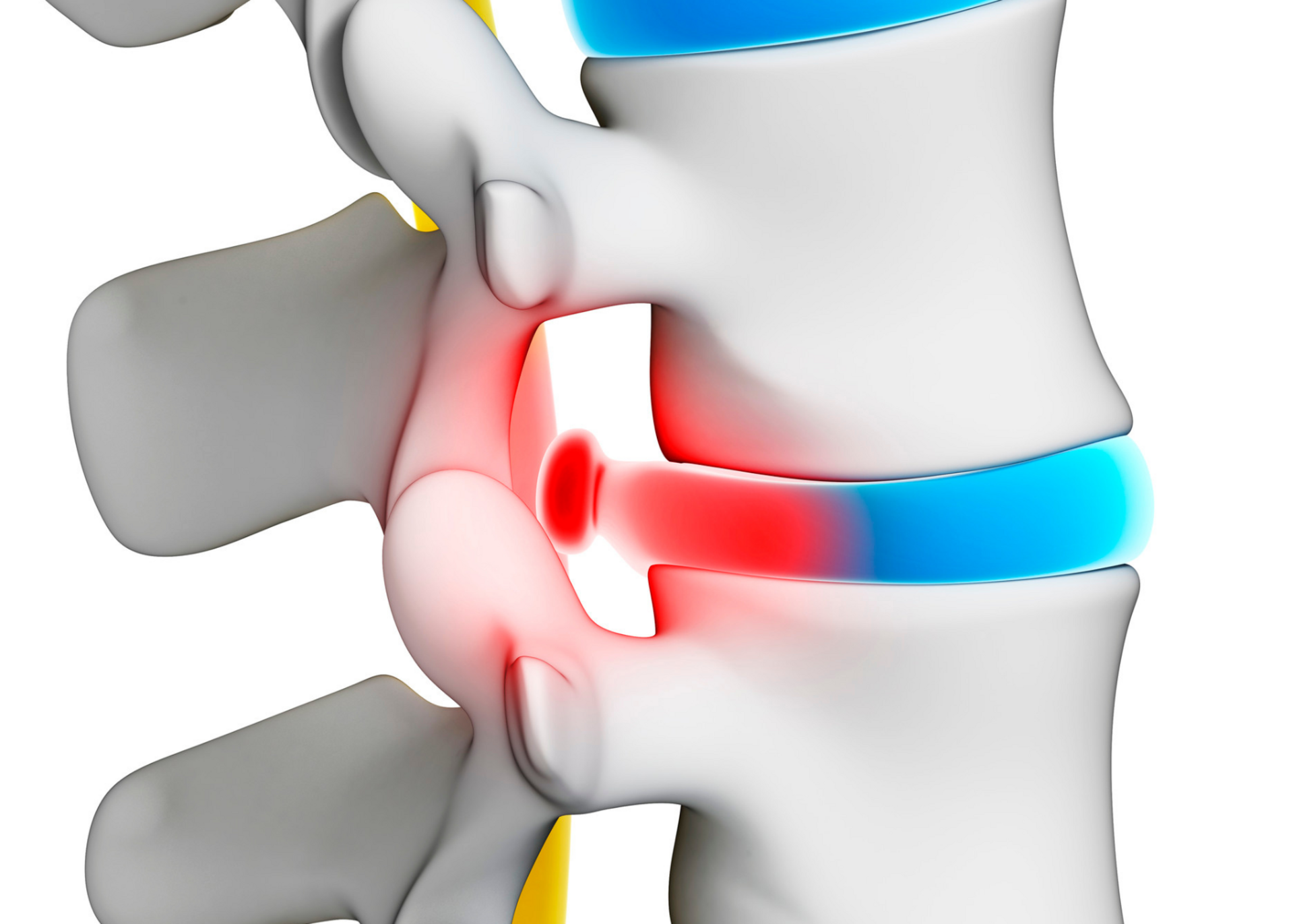 Cervical Disc Surgery