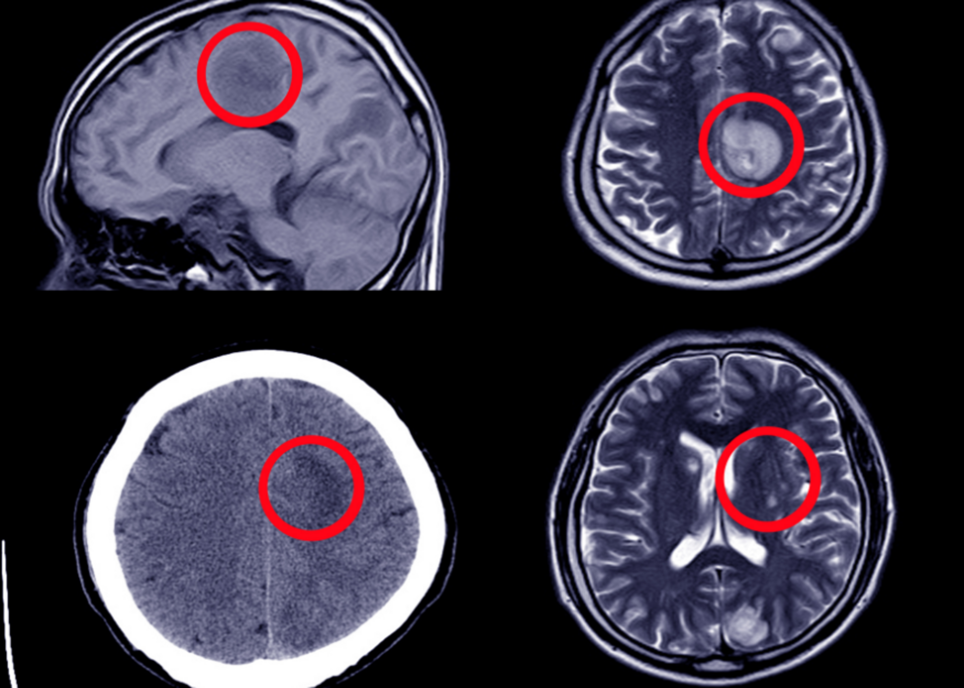 Hydrocephalus Treatment